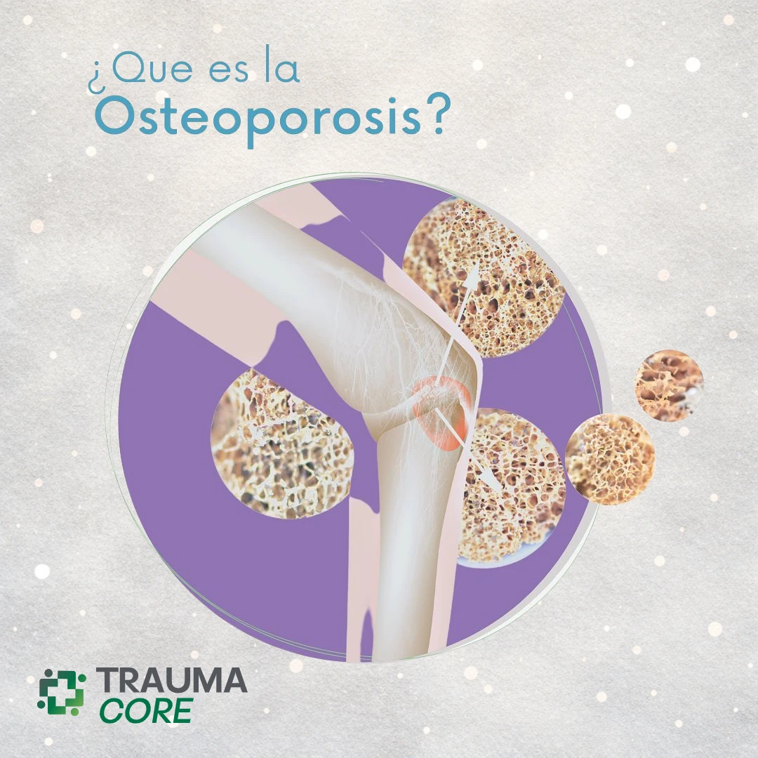 Qué es la osteoporosis @ TraumaCore - Núcleo Traumatológico Especializado • Santo Domingo, República Dominicana